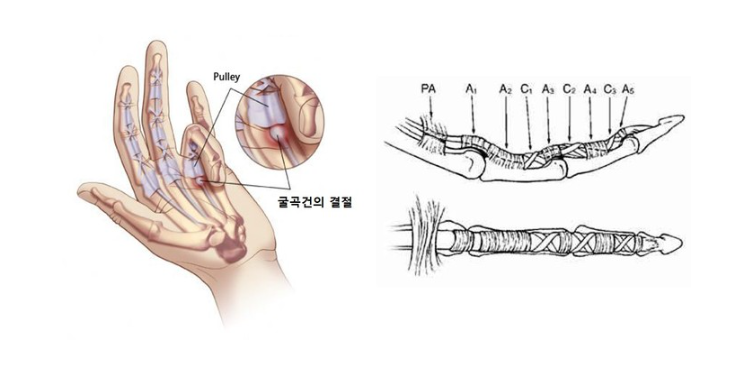 방아쇠수지 증후군 치료부터 수술비, 회복기간까지 쉽게 정리해볼게요.