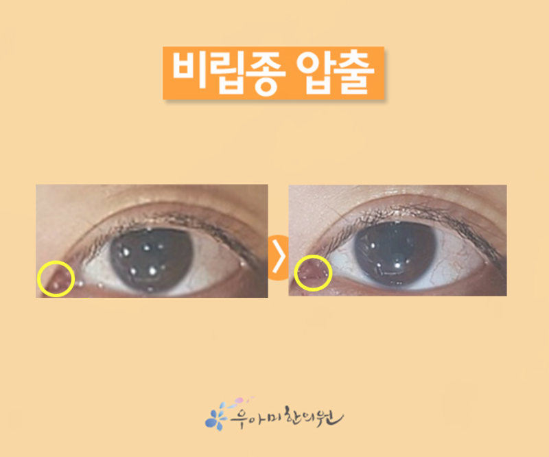 눈 앞머리 비립종, 피부과와 안과 어디로 가야 할까요?