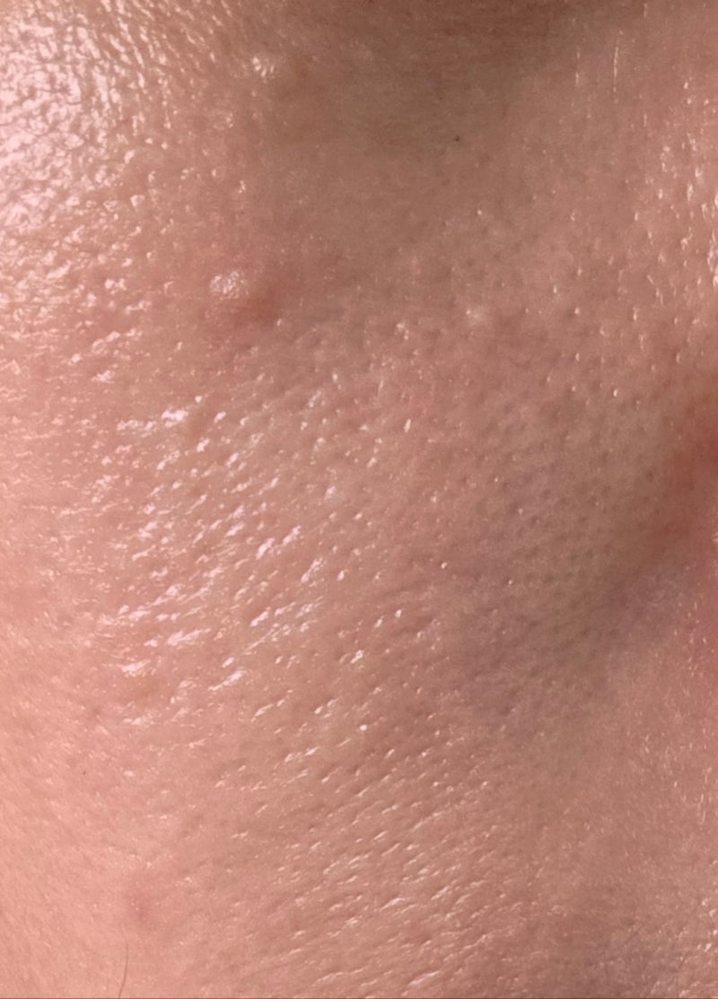 피부과 가기 전 필독!! 비립종,편평사마쉬 원인과 치료비 아끼는 방법