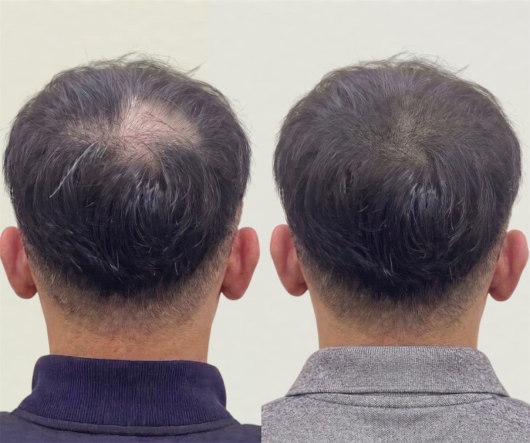  부천두피문신, 가격보다 중요한 건 3년 뒤에도 자연스러운 결과입니다
