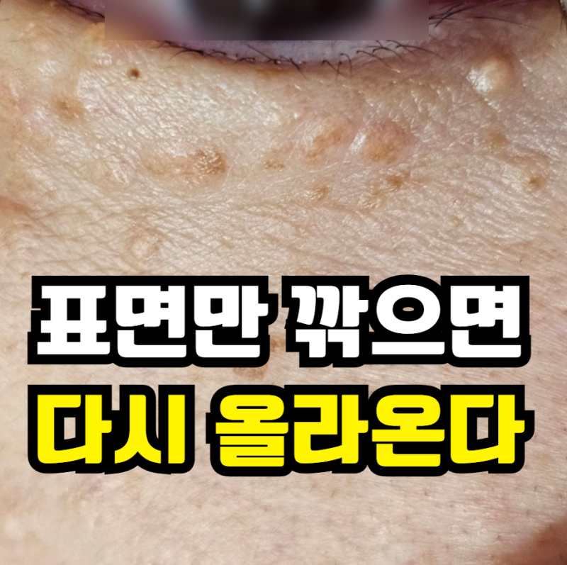 얼굴 전체로 번진 한관종, 포텐자 고주파 소작법이 정말 답일까?