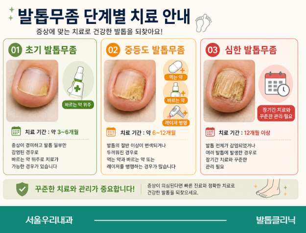 동탄역 발톱무좀 치료 기간은 얼마나 걸릴까요?