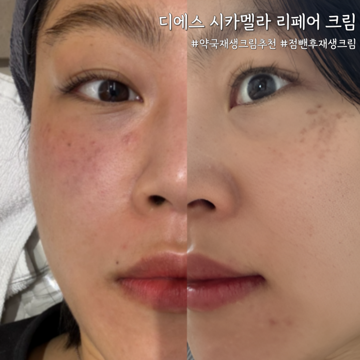  점뺀후재생크림 추천, 디에스 시카멜라 리페어 크림 사용 후기