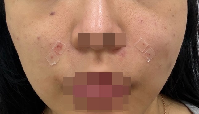  부산 서면실리프팅 내돈내산 2주차 솔직 후기(붓기,멍, 효과, 회복기간)