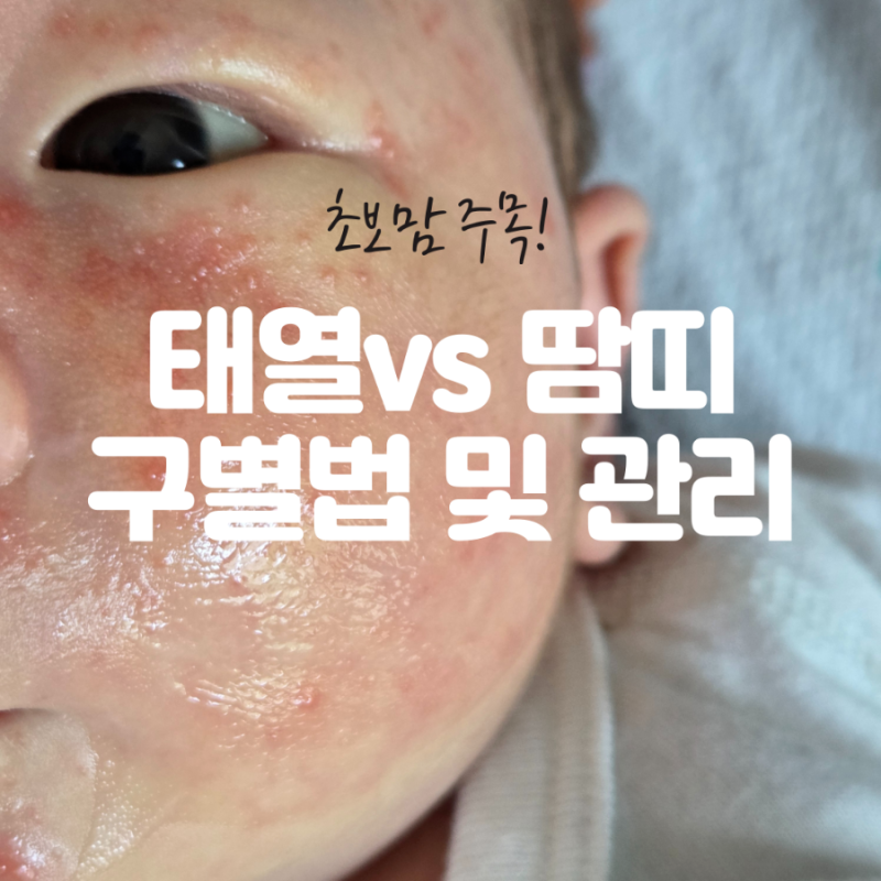 신생아 아기 태열, 땀띠 증상 구별 방법과 관리법