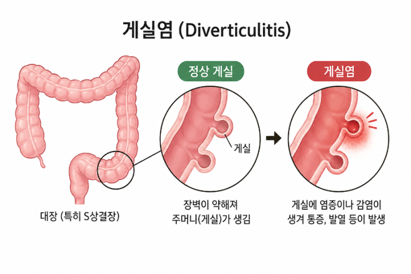 "단순 복통인 줄 알았는데?" 대장에 염증이 생기는 '게실염' "게실염 방치하면 장 천공까지?" ....