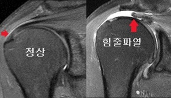 어깨 MRI 정상인데 계속 아픈 이유｜원인부터 검사 시기·비용까지