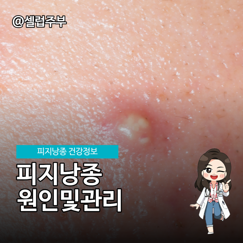겨드랑이 두피 피지낭종 원인과 관리법! 방치해도 괜찮을까?