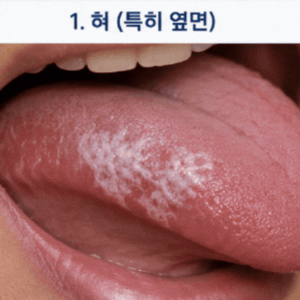 구강백반증, 칫솔로도 닦이지 않는 '입안 흰 반점' 방치하면 안 되는 이유