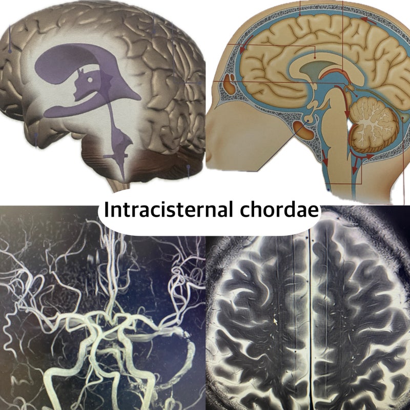 Intracisternal Chordae (지주막 소주, 거미막 기둥)