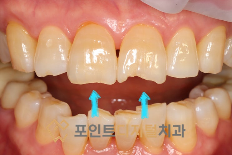  [탕정치과] 깨지고 금 간 앞니 고민, 치아 삭제 없이 하루 만에 복구하는 전치부 레진 빌드업 / 천안 아산
