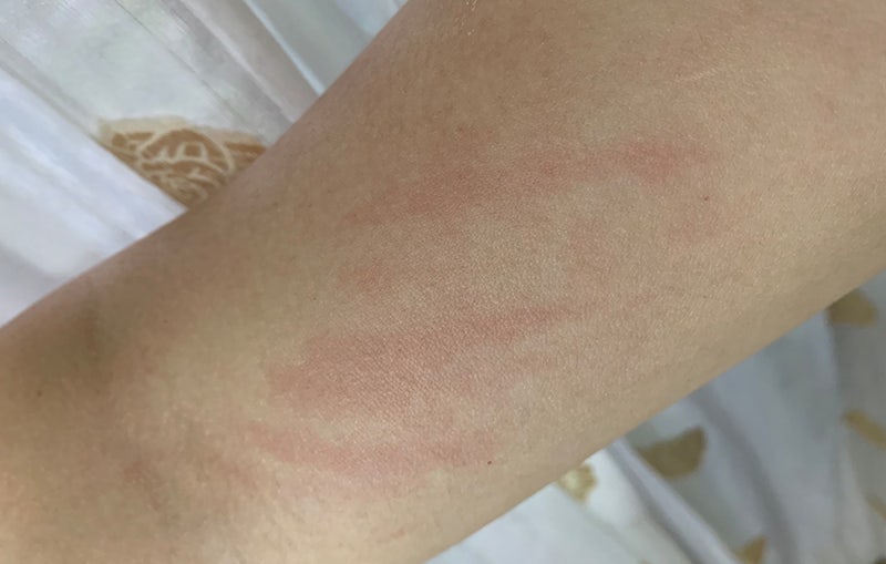 피부묘기증 원인 부어오름 간지러움 가려움 열감 증상 약 연고 그만!