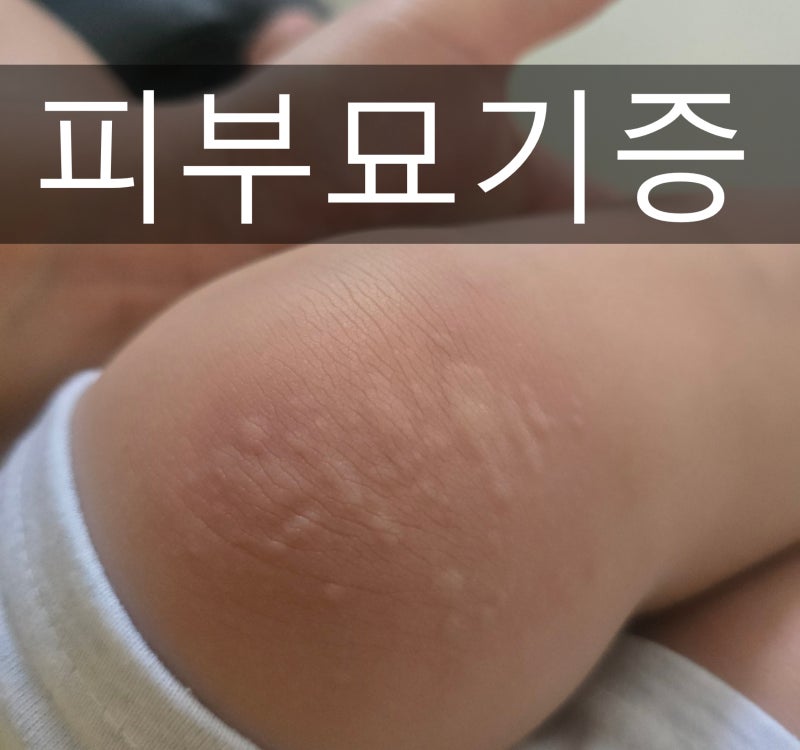 피부묘기증 증상 및 대처방법