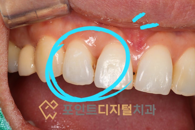  [천안 치과] 교정 유지장치 제거 없이 앞니 레진 치료 가능할까? (#12 충치 치료 케이스) / 천안 아산