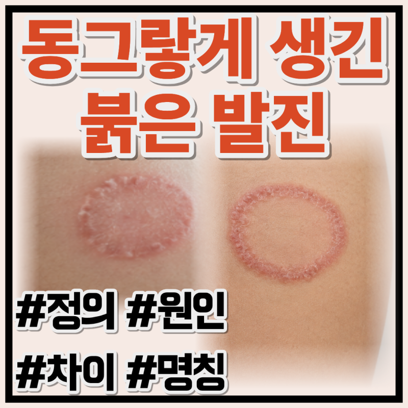몸에 생긴 동그랗게 붉은 발진 체부백선 정의와 원인파악하기(ft. 습진과 백선의 차이, 백선....