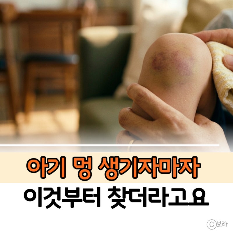 냉찜질만 할까 아기멍연고 바를까 부모들 선택 갈린 이유