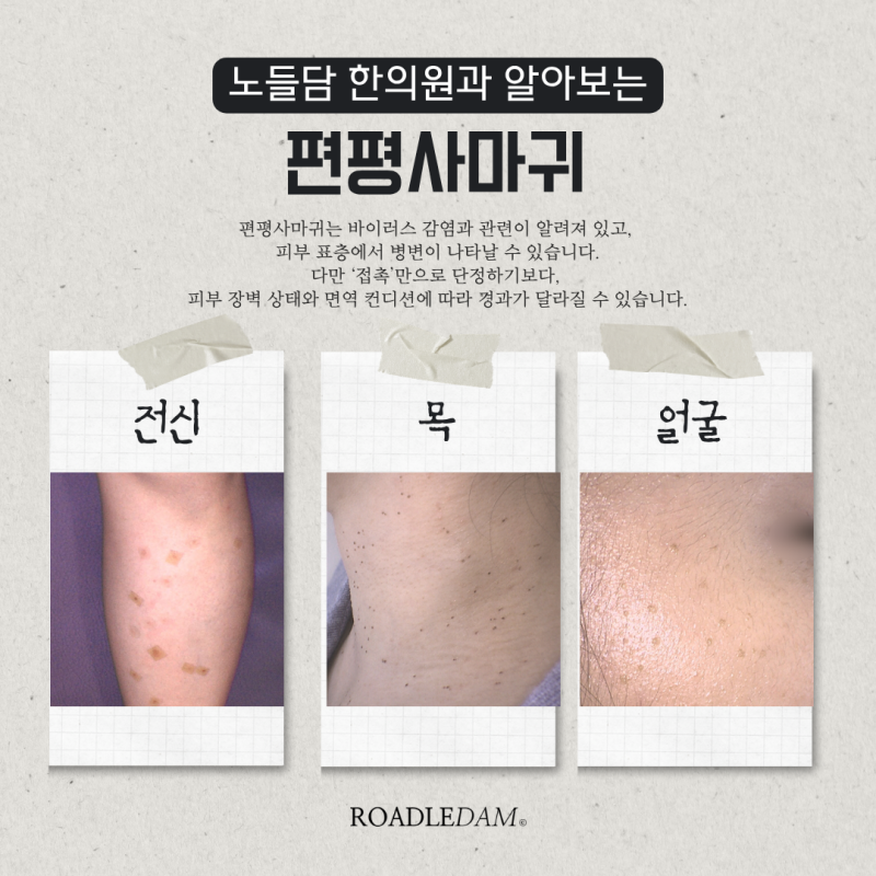 손등 편평사마귀 원인, 제거, 연고 치료 효과