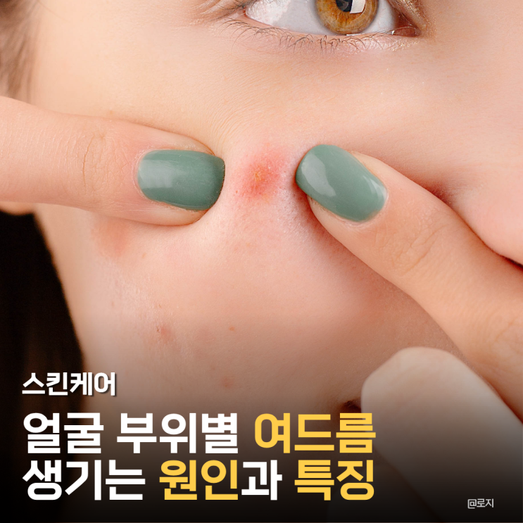  얼굴 부위별 여드름 뾰루지 생기는 원인과 특징 없애는 법