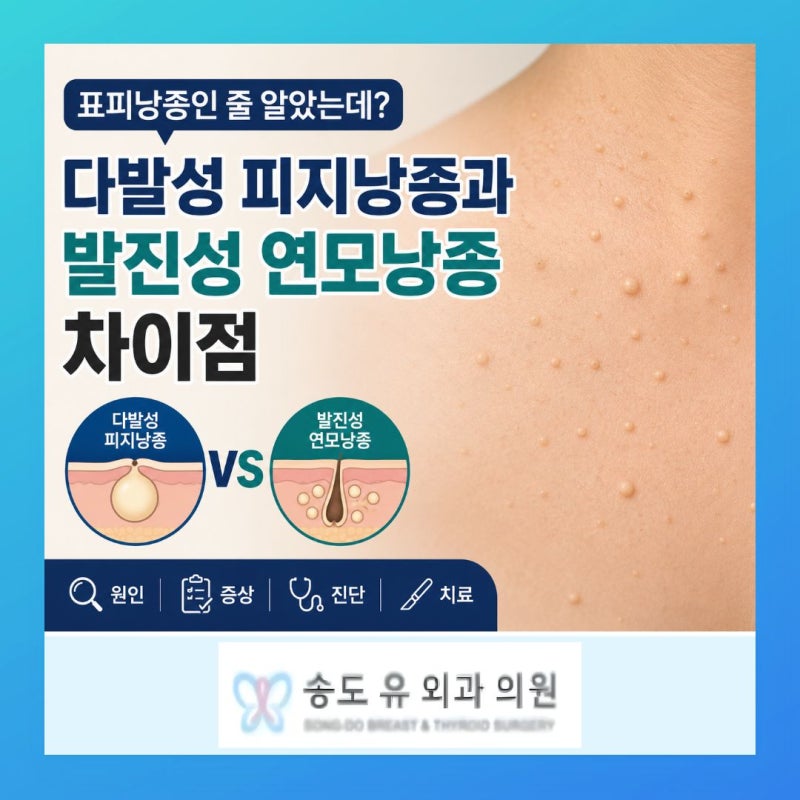 "표피낭종인 줄 알았는데?" 인천 구월동 다발성 피지낭종과 발진성 연모낭종 차이점