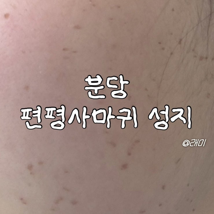 분당 편평사마귀 성지, 얼굴전체 10만원대 시술후기 (병원정보 공유)