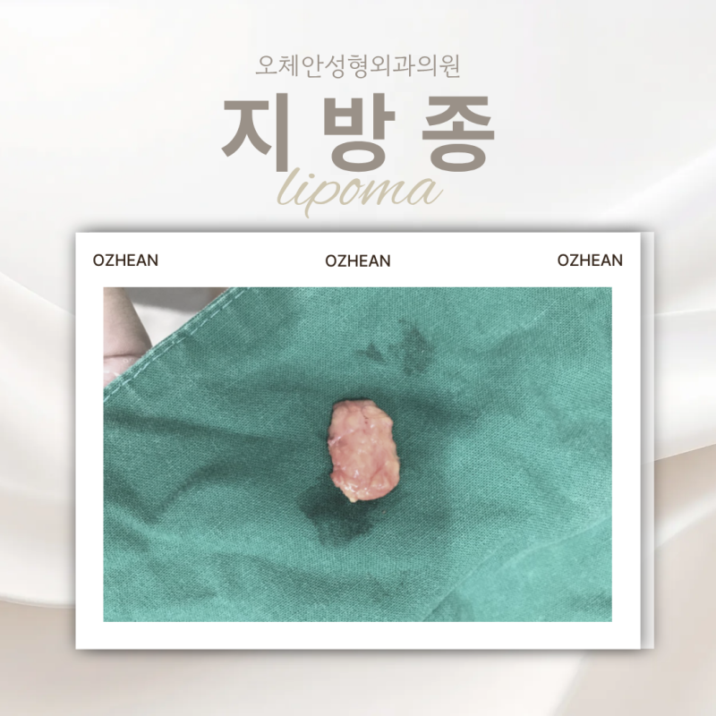 뒤통수 몽우리, 지방종이라면 어떻게 치료할까?