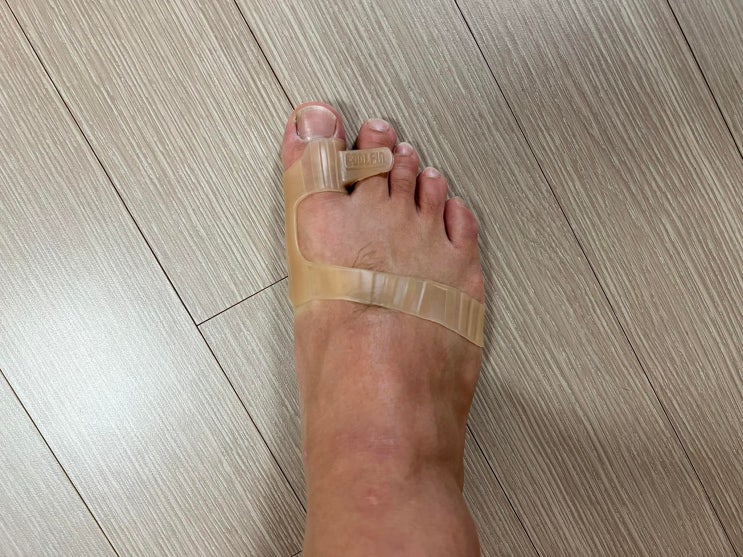  발가락 교정기 무지외반증 관리에 필요한 선택 조건 3가지