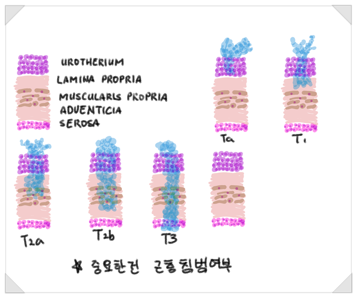 방광암, 피가 섞인 소변이 보내는 경고 신호