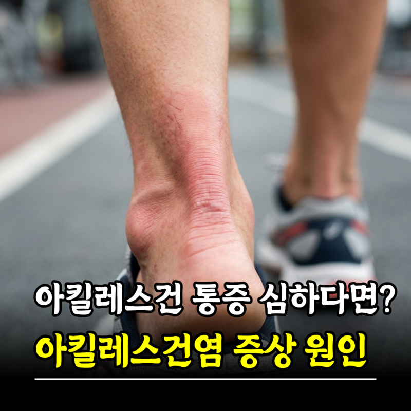 아킬레스건 통증 심하다면? 아킬레스건염 증상 원인 관리법