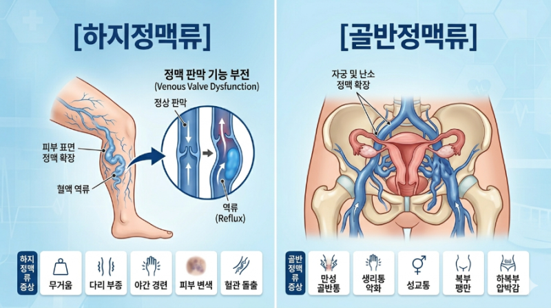 하지정맥류 골반정맥류(골반울혈증후군) 시술 확정 그리고 통증 치료