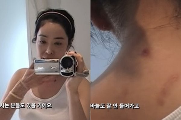 이혜영 폐암 투병 6년 온몸 흉터 고백…부은 눈 때문에 쌍수 오해까지 견뎌낸 시간
