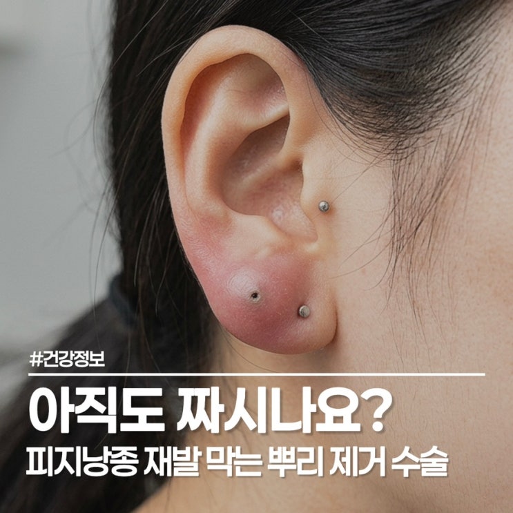  피지낭종 제거, 흉터 없이 깔끔하게 끝내는 방법은?