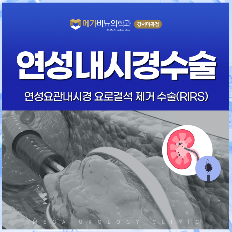 요로결석수술 연성내시경 치료, 직접 돌을 제거하는 방법