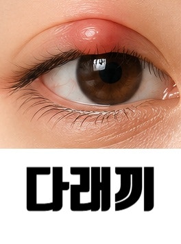 [대전 유성성모안과] 다래끼