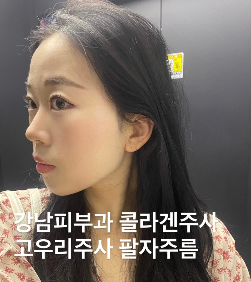 강남역피부과 고우리 팔자 나이 들수록 고민되는 팔자 눈가 잔주름 해결사! 고우리주사 스킨....