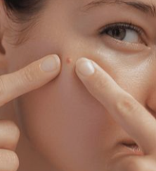  좁쌀여드름 압출 vs 스팟 케어, 뭐가 더 나을까?