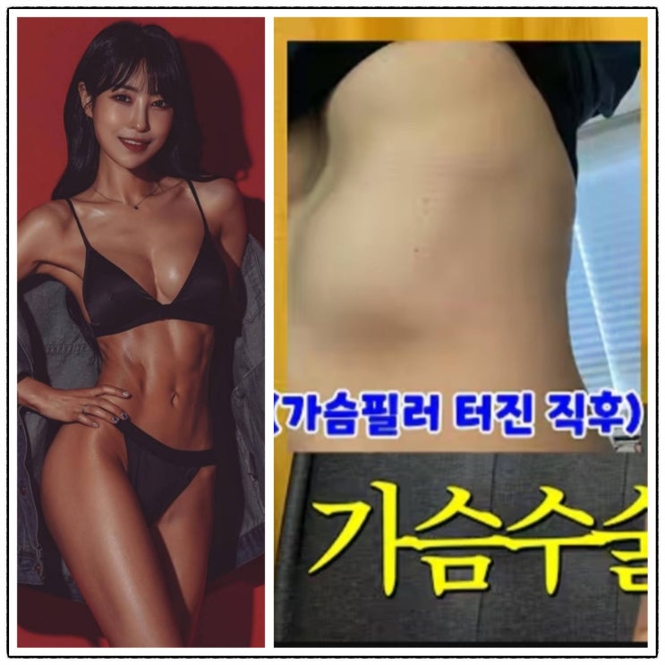 <b>개그우먼</b> <b>이세영</b> 가슴 필러 부작용 가슴 4개?