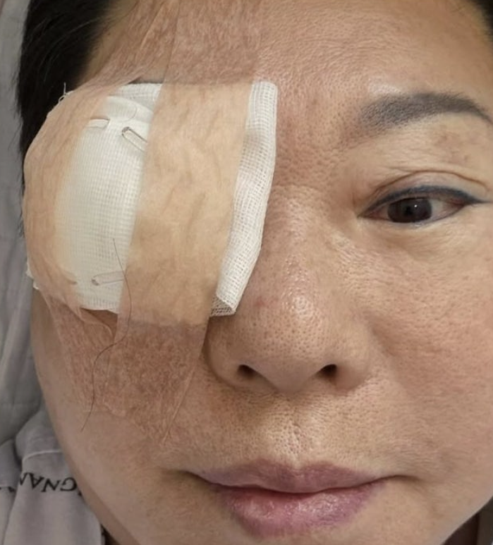 <b>양희은</b>, <b>각막이식 수술 근황</b> 공개 "난소암 극복 이어 또 건강 고비"