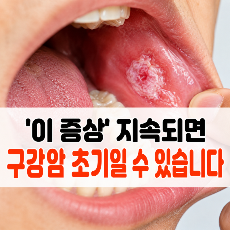 "단순 구내염 아닐 수 있습니다"구강암 의심해봐야 할 초기 증상 3가지..지금 체크 해보세요