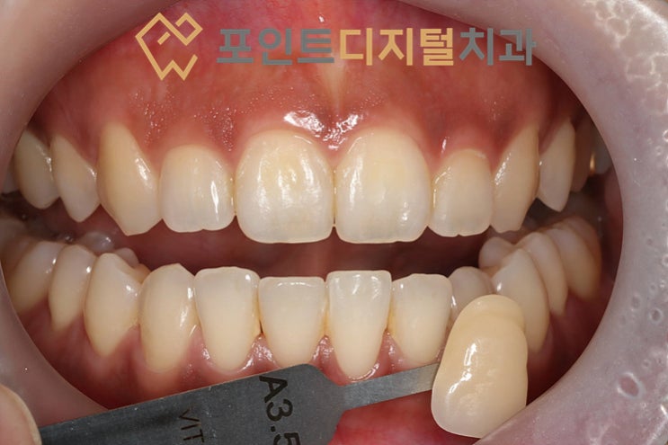  [천안 치아미백] 누런 이 콤플렉스? 30대 직장인 치아미백, A3.5에서 초명도 BL3까지 밝아진 비결! (ft. 미백폭발코스)