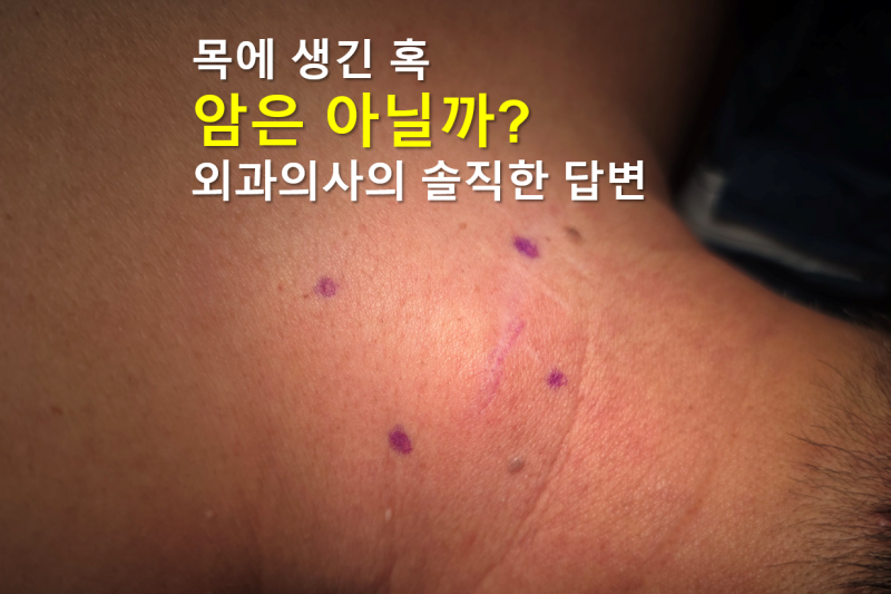 목 지방종 혹 같은 것이 의심된다면?