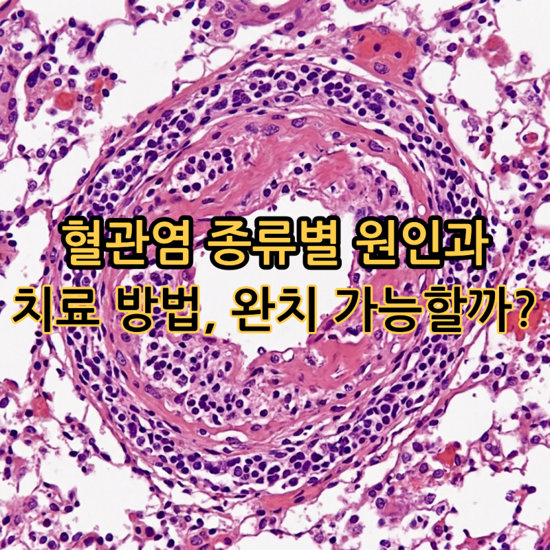 혈관염 종류별 원인과 치료 방법, 완치 가능할까?