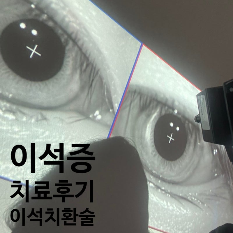 20대 이석증검사 이석치환술 후기 - 이석증에 좋은 음식 습관 예방