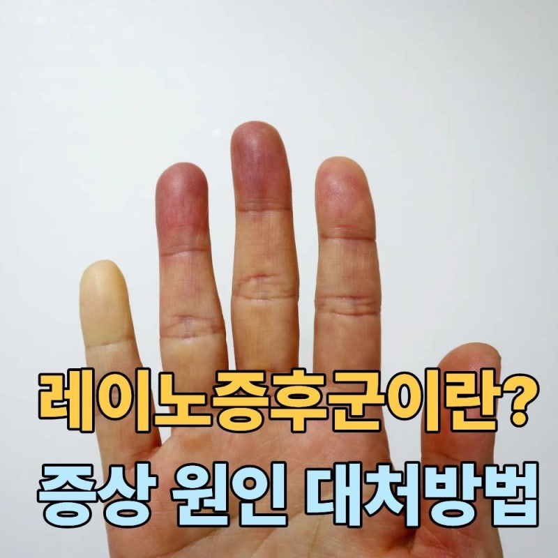 레이노증후군 증상 및 원인-손끝이 하얗게 변하고 저리다면?