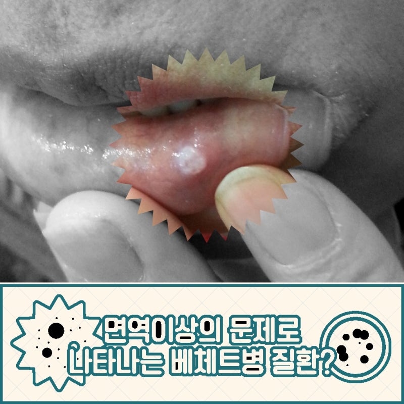 원인 모를 전신 통증 자가면역질환 루푸스 의심 증상일까요