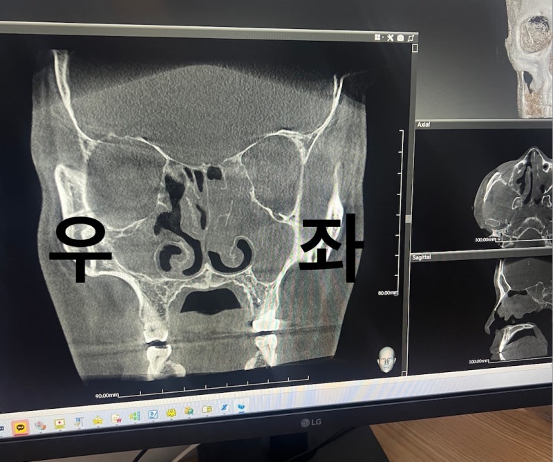 축농증 수술 후기 1편 | 왜 진작 수술하지 않았을까? 20년 만에 받은 축농증 재수술 후기 (+주....