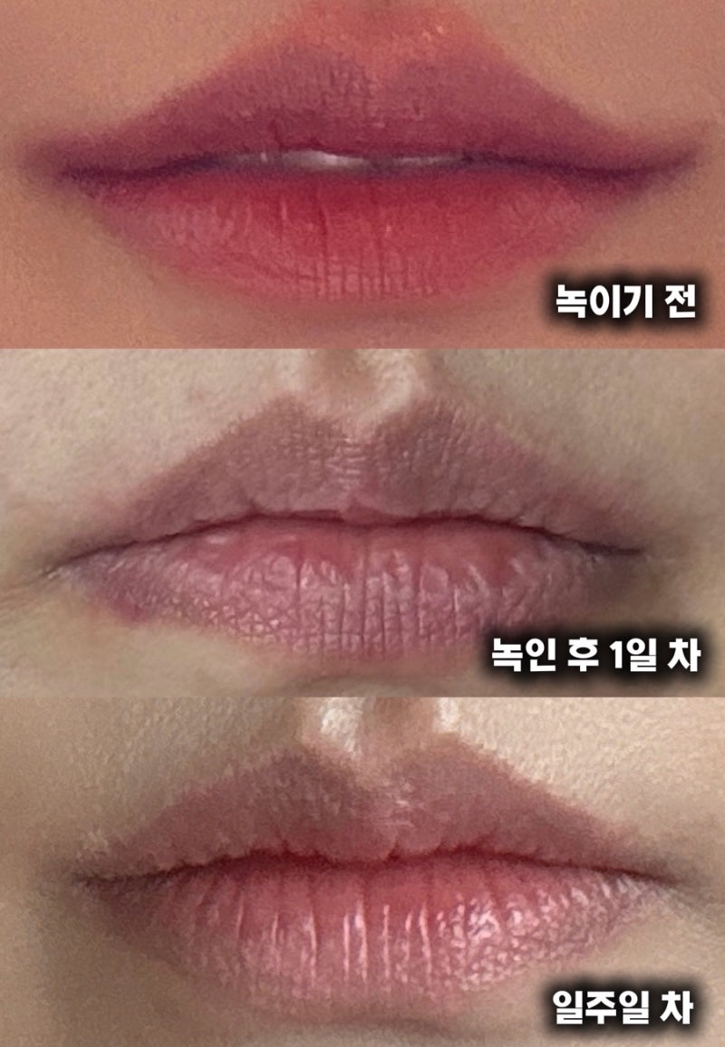 입술필러 제거 녹이기 전 꼭 알아야 할 통증 붓기 비용 히알라제 부작용