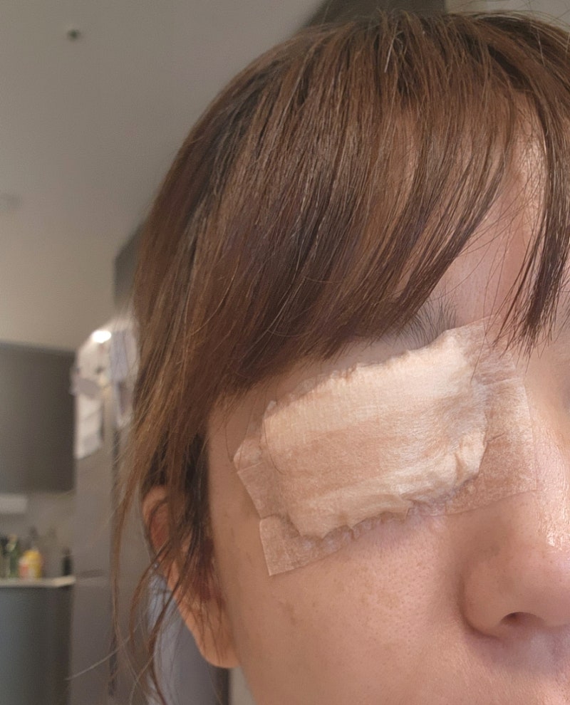 눈다래끼 수술 후기, 약으로 버티다 실패 보험청구 방법