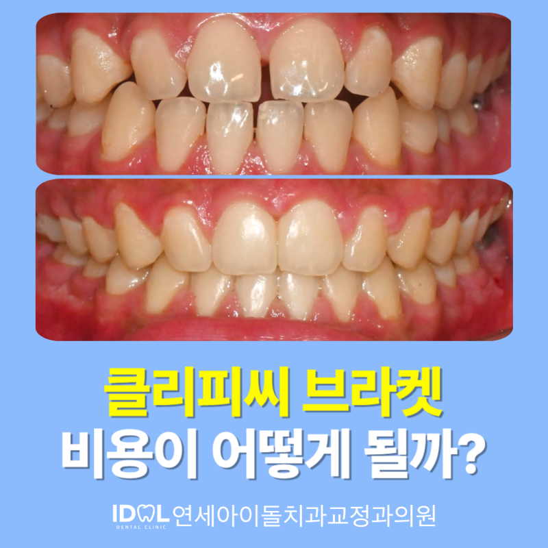 클리피씨 교정 비용 궁금하다면? 앞니 벌어짐 개방교합 비발치 전체교정 케이스