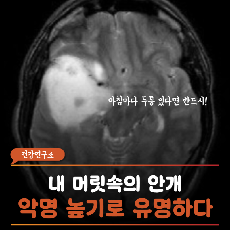 아침마다 깨질 듯한 두통, 타이레놀로 버티다 교모세포종 진단받는 이유