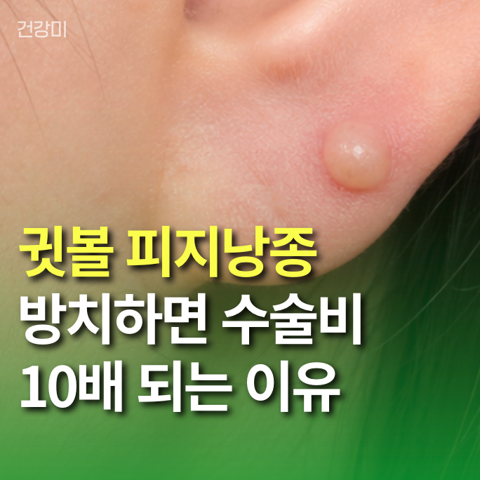 귓볼 피지낭종 짜지 마세요! 방치하면 수술비 10배 되는 이유